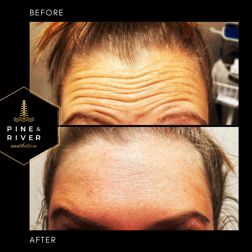 Before-_-After-Botox-Forehead-1.13.22