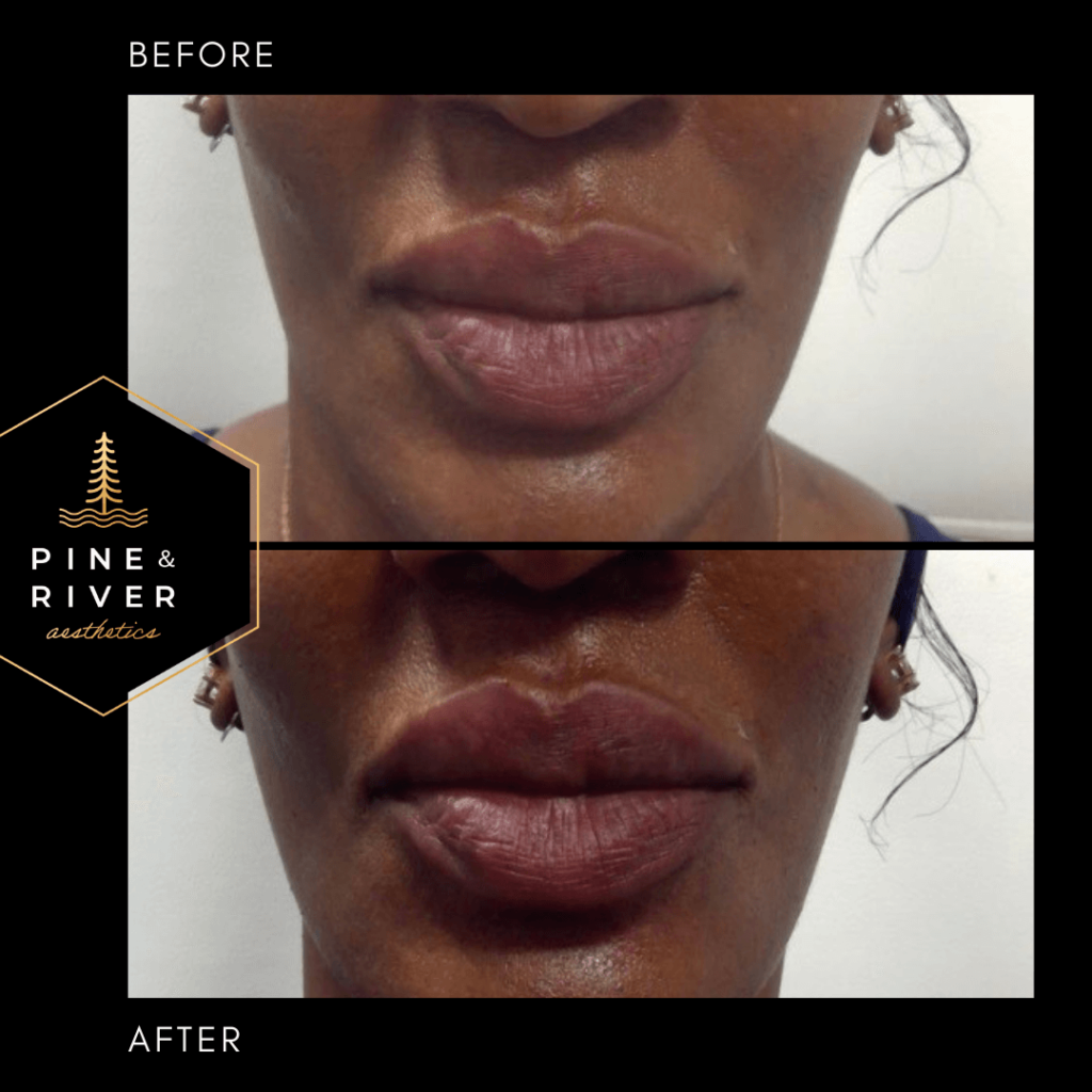 Before-_-After-Lip-Filler-5.10.22