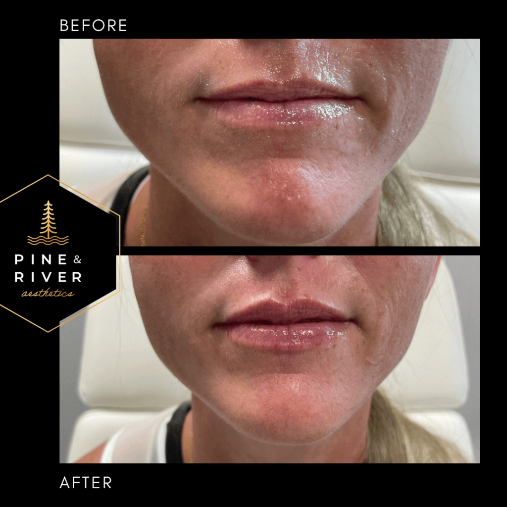 Before-_-After-Lip-Filler-7.21.22