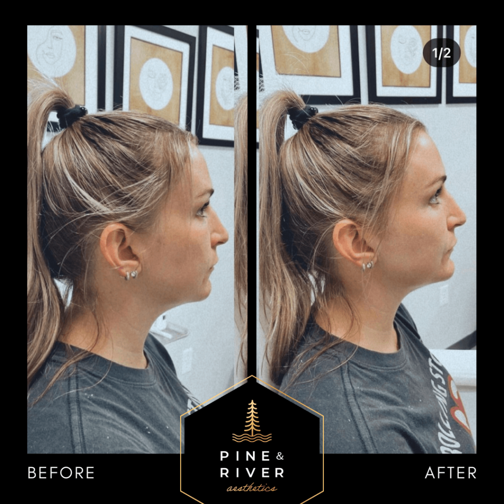 Before-_-After-RHA-4-Chin-Filler-1.13.22-1