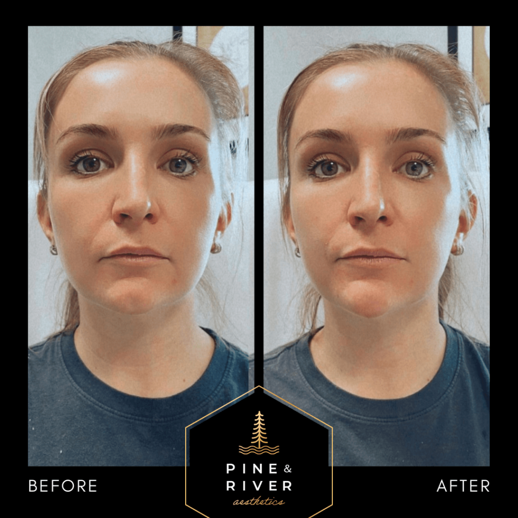 Before-_-After-RHA-4-Chin-Filler-1.13.22-2