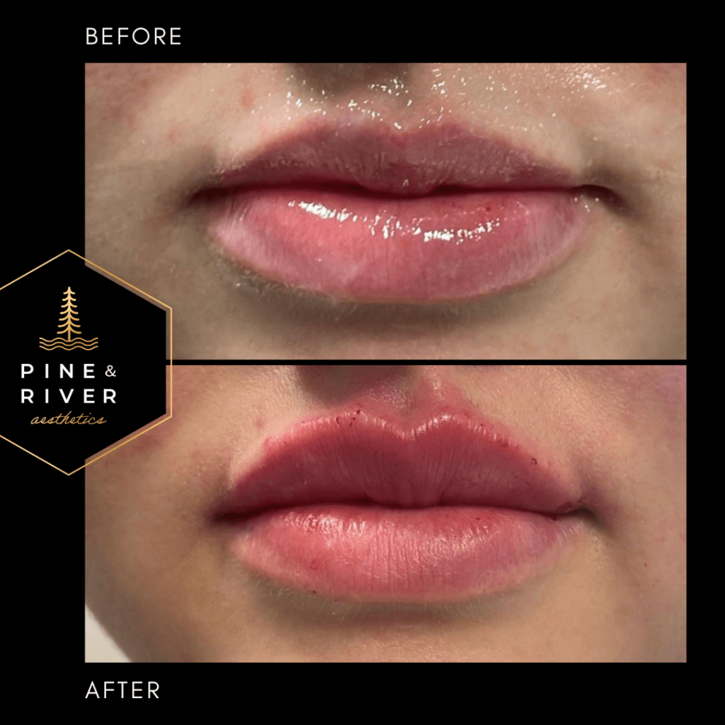 Before-_-After-Restylane-Kysse-Lip-Filler-1.13.22