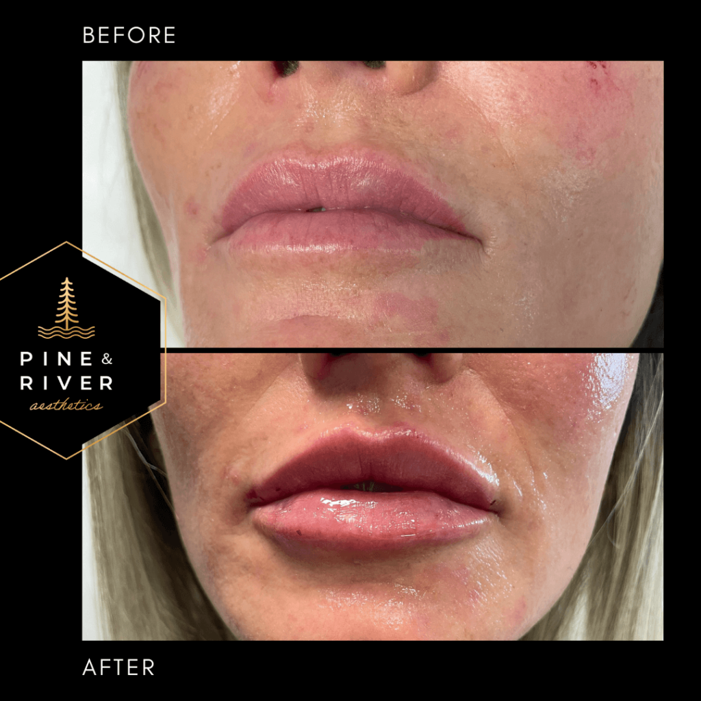 Before-_-After-Restylane-L-Lip-Filler-1.28.22