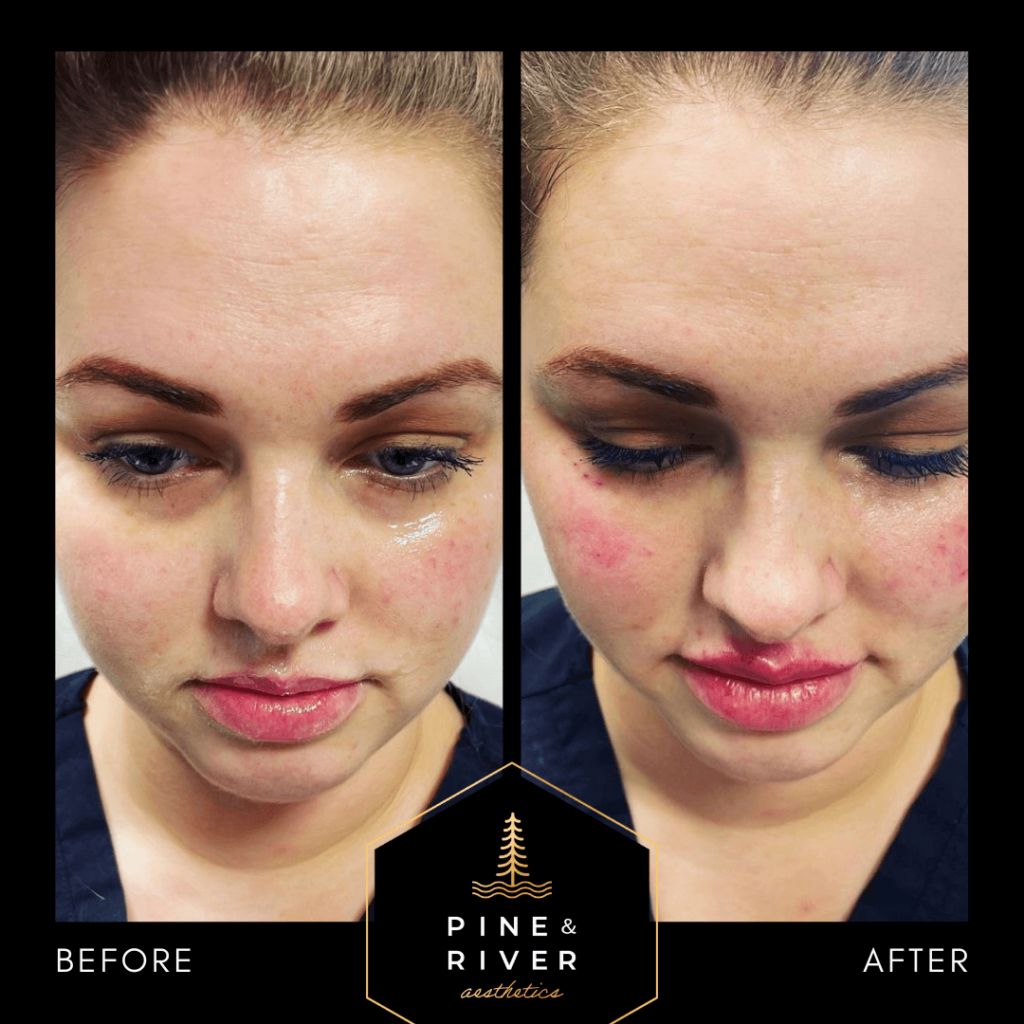 Before-_-After-Restylane-L-Tear-Trough-Filler-1.13.22
