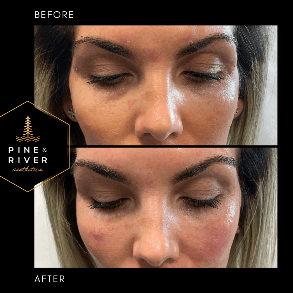 Before-_-After-Restylane-L-Tear-Trough-Filler-1.28.22