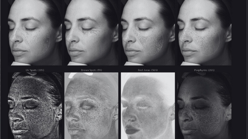 VISIA skin analysis results showing UV damage, brown spots, redness, porphyrins, and underlying skin concerns during a skin consultation at Pine & River Aesthetics.