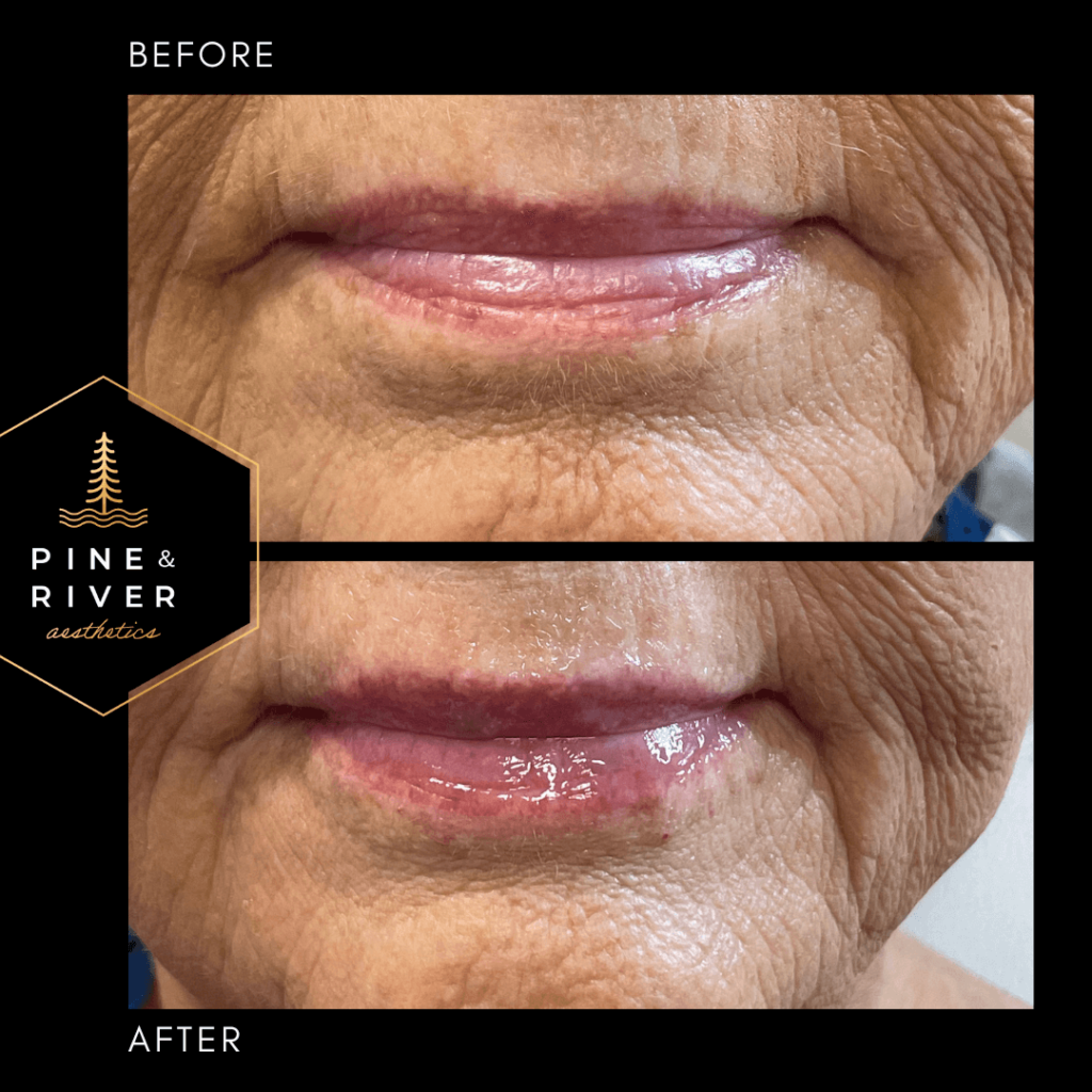Lip-Filler-7.11.22 Before and After