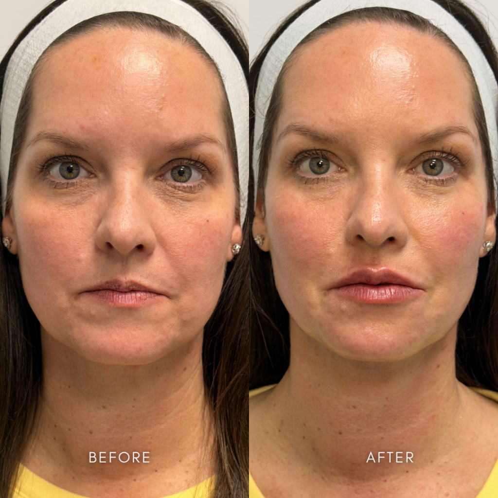 Before and after facial balancing treatment performed at Pine & River Aesthetics in Little Rock, Arkansas, showing improved facial harmony, enhanced cheek support, softer under-eye appearance, and natural lip enhancement using strategically placed dermal fillers.