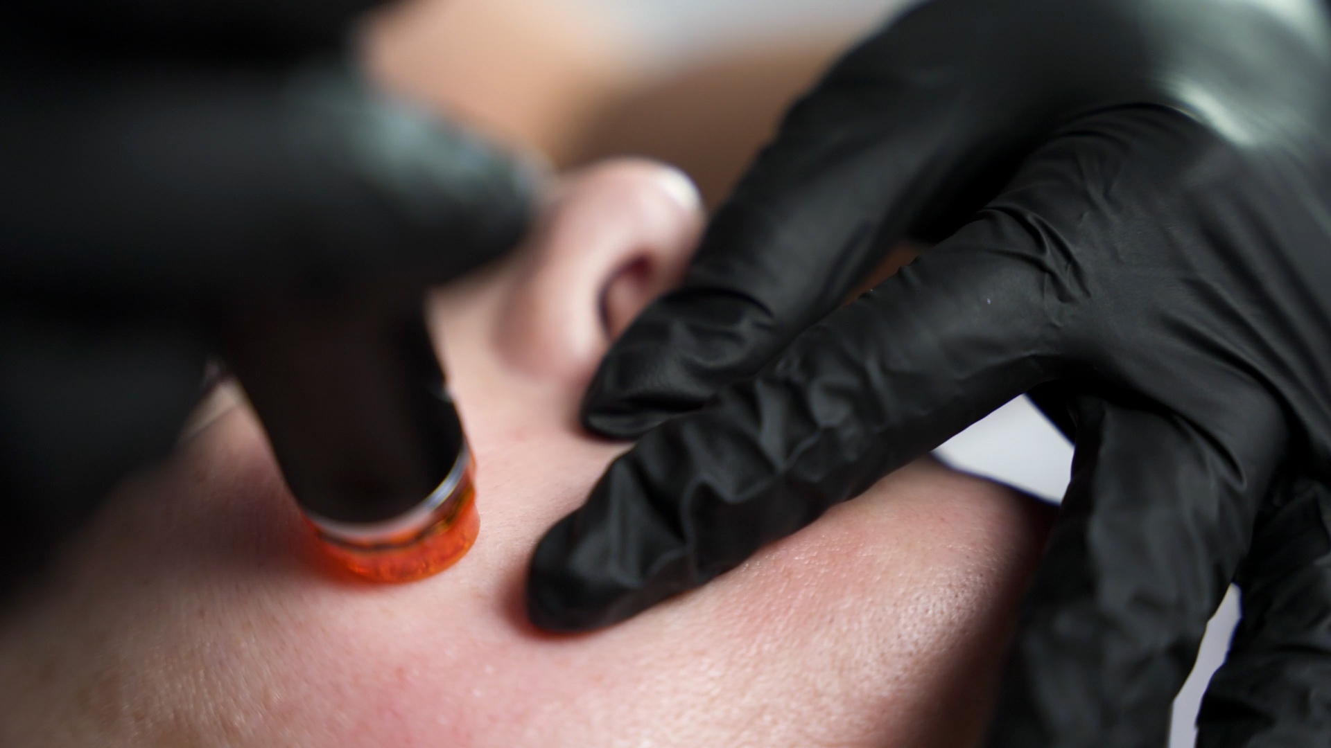 HydraFacial treatment
